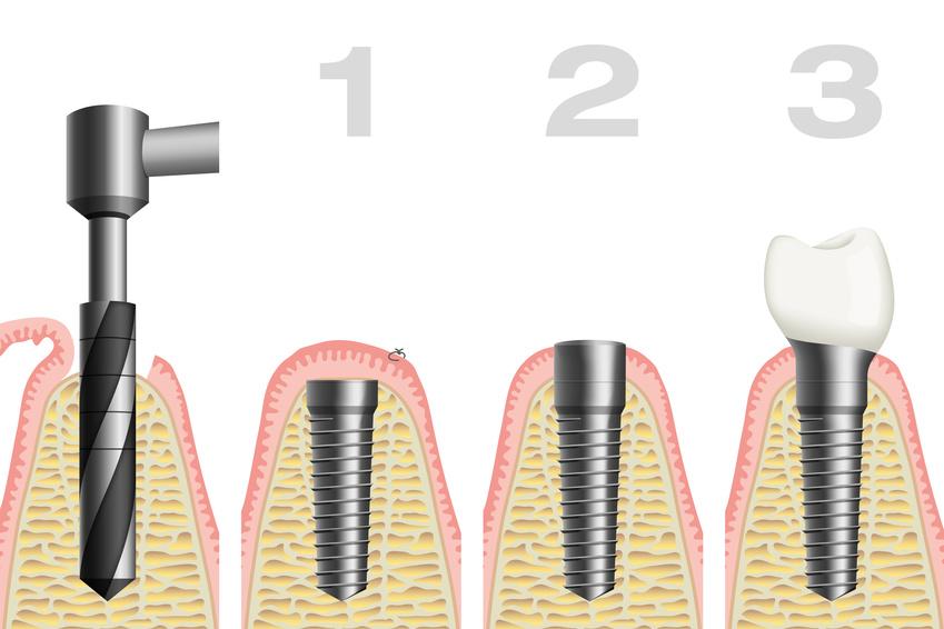 Einsetzen eines Implantats