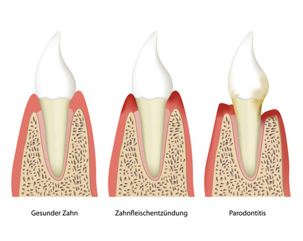 Illustration: Stufenweise Entstehung einer Parodontitis: 1. gesunder Zahn, 2. Zahnfleischentzündung, 3. Parodontitis