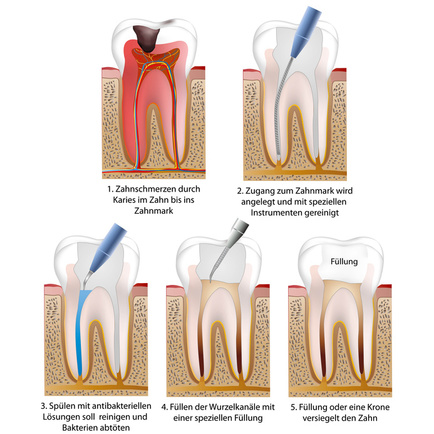 Wurzelbehandlung in mehreren Schritten 