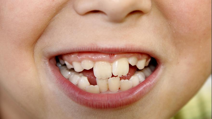 Milchzahngebiss eines Jungen mit schiefen Zähnen