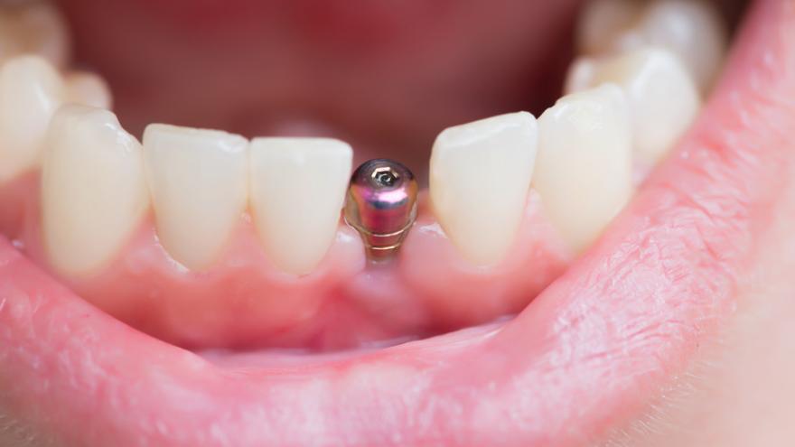 Implantat ohne Zahnkrone