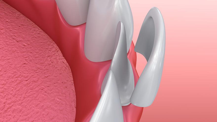 Dentalveneers: Installationsverfahren für Porzellanfurniere. 3D-Illustration 