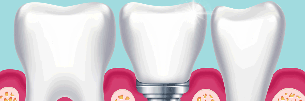Grafik: Implantat als künstliche Zahnwurzel