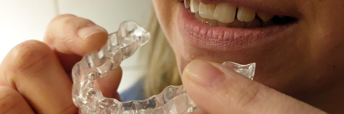 Hände halten transparente Zahnschiene vor geöffnetem Mund