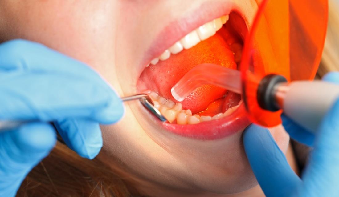 Zahnbehandlung - Härten einer Kompositfüllung