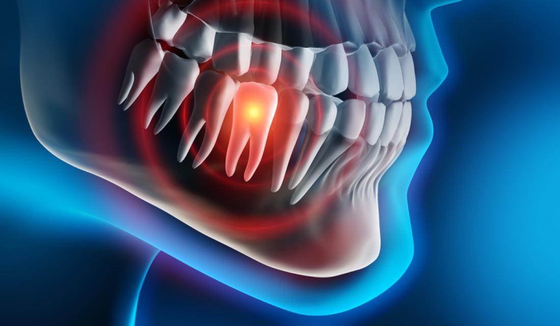 Röntgenbild des Schädels zeigt Zahnentzündung/Karies