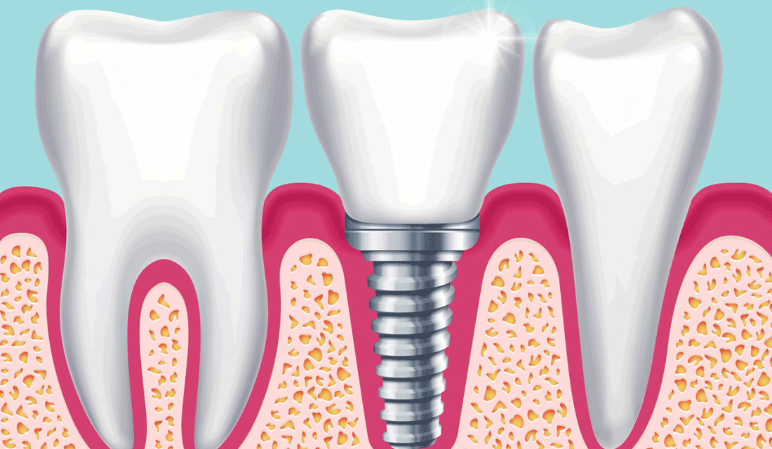 Grafik: Implantat als künstliche Zahnwurzel